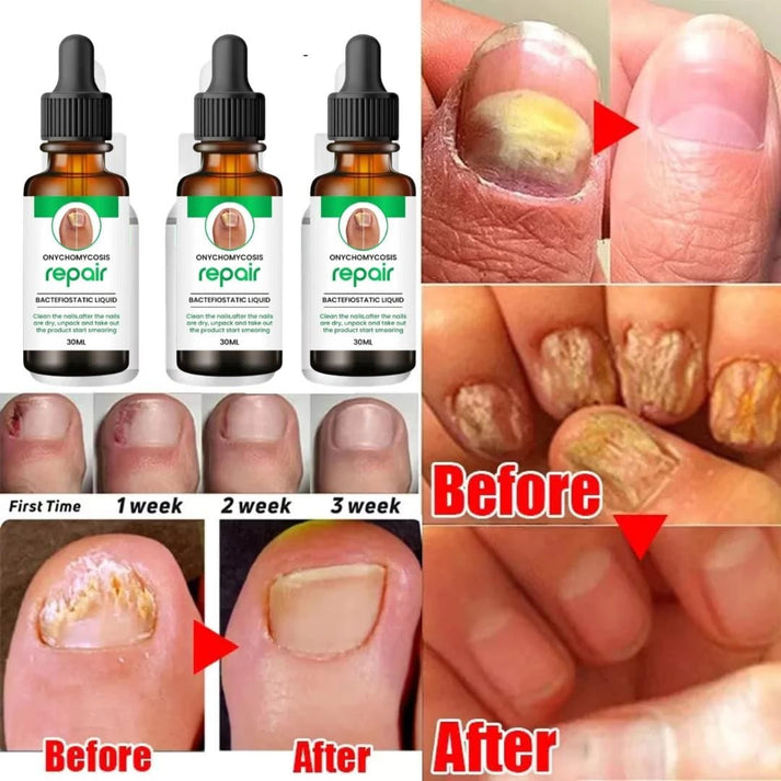NailVeda™ Advanced Nail Growth & Repair Serum